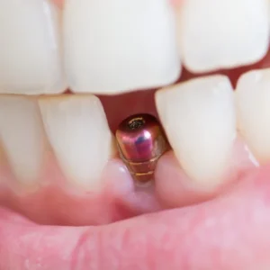 Read more about the article Is Getting Single day Dental Implants the Right Decision for You