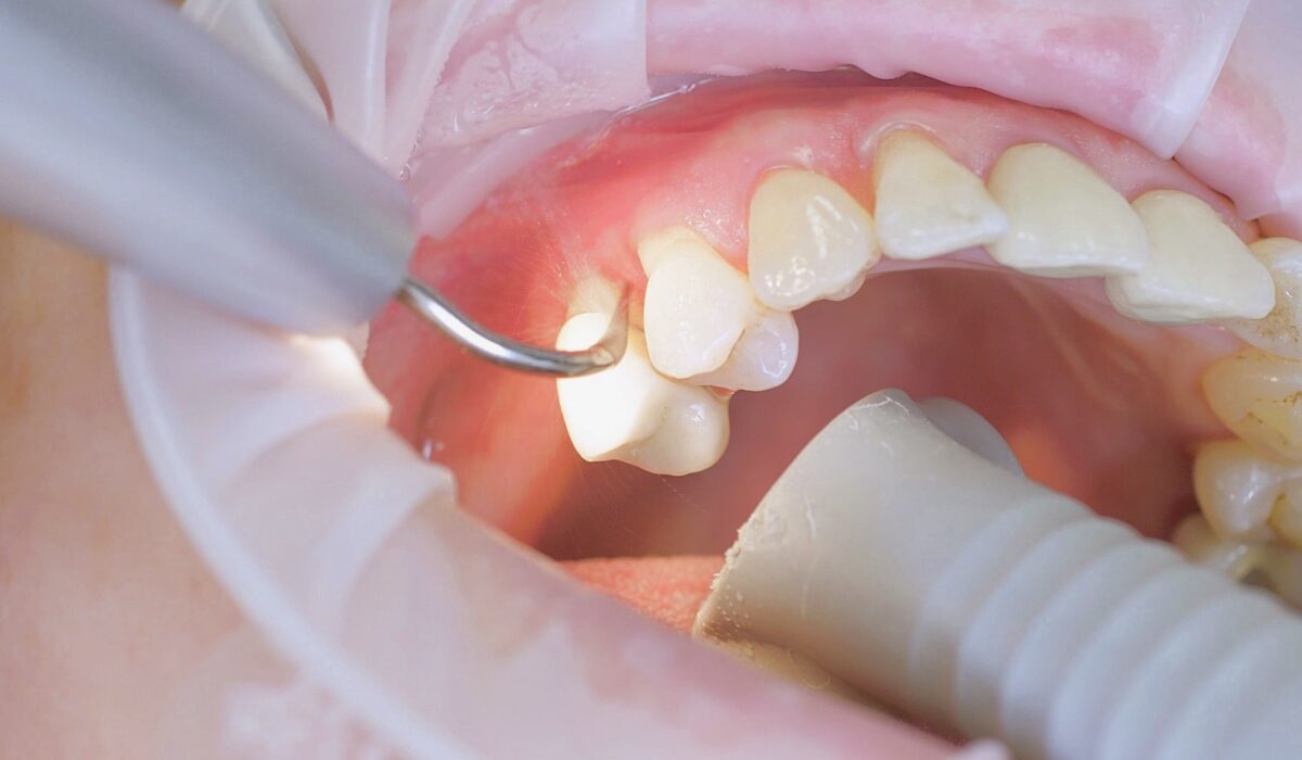 Root Canal treatment in Howrah