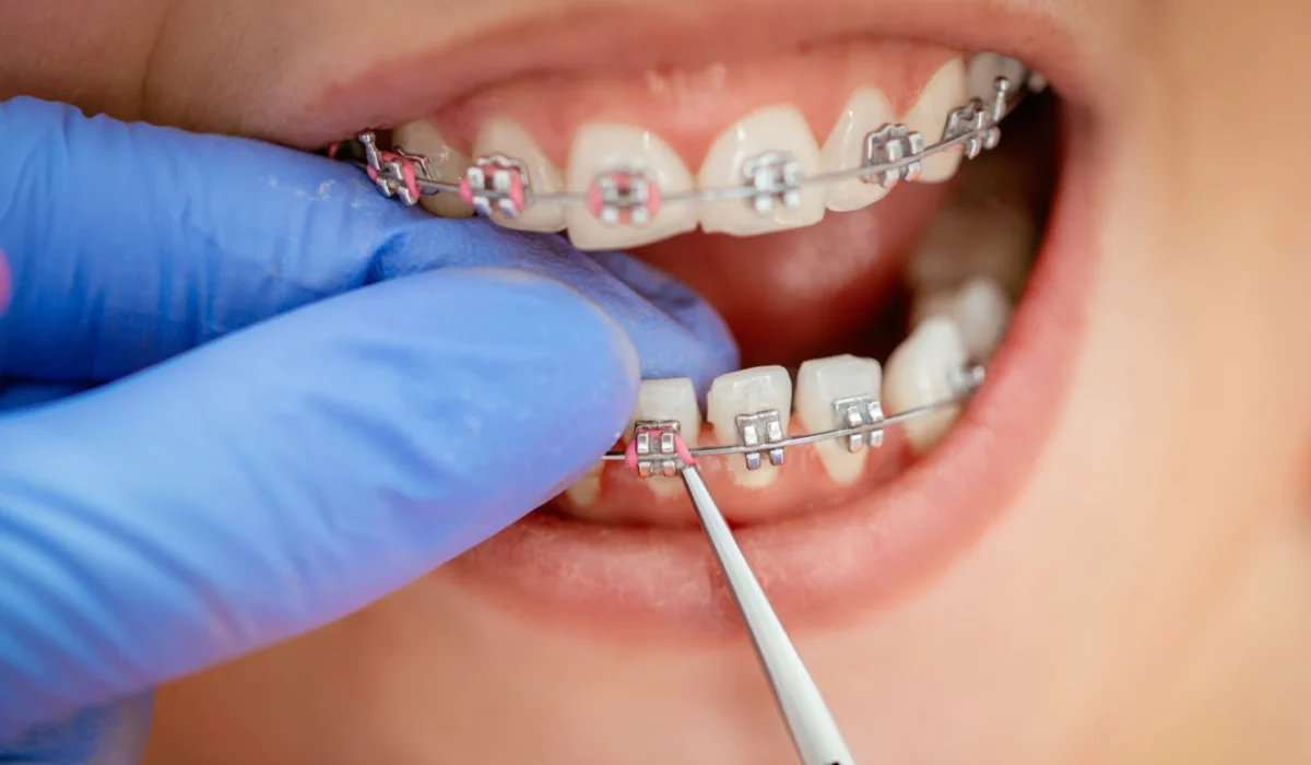 Dental Braces in Howrah