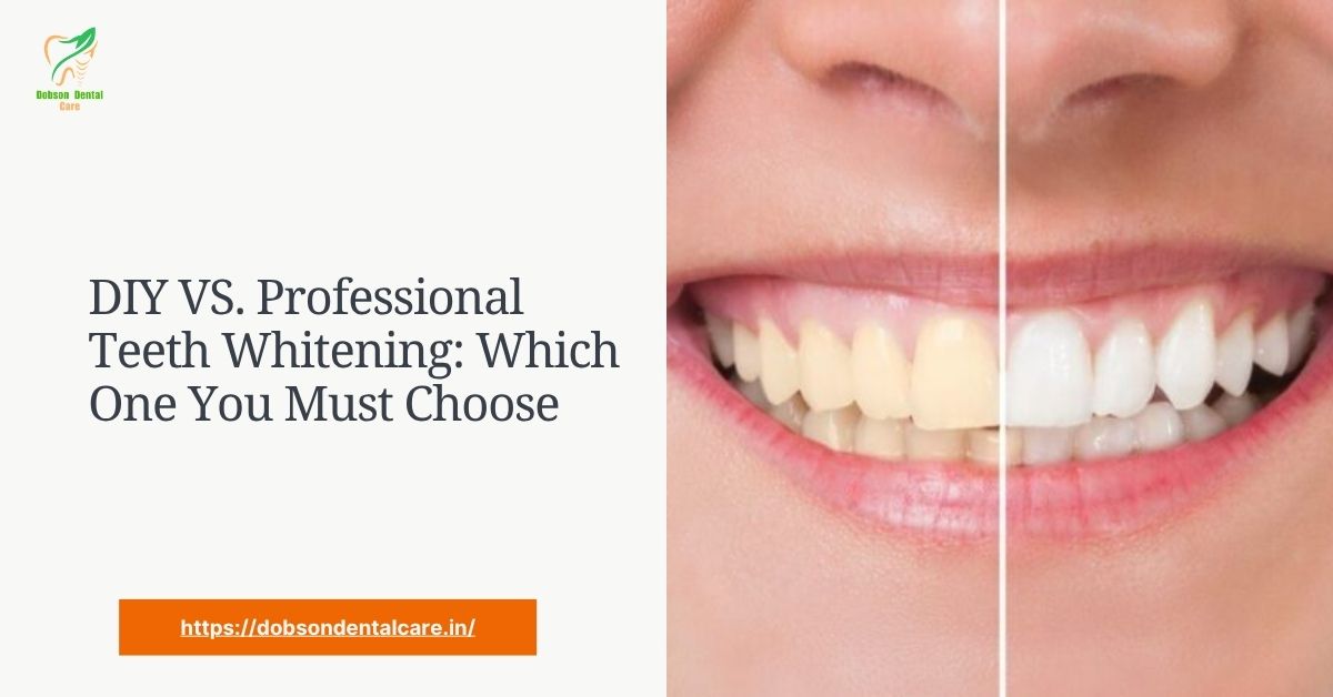 You are currently viewing DIY VS. Professional Teeth Whitening: Which One You Must Choose