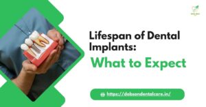 Read more about the article Lifespan of Dental Implants: What to Expect