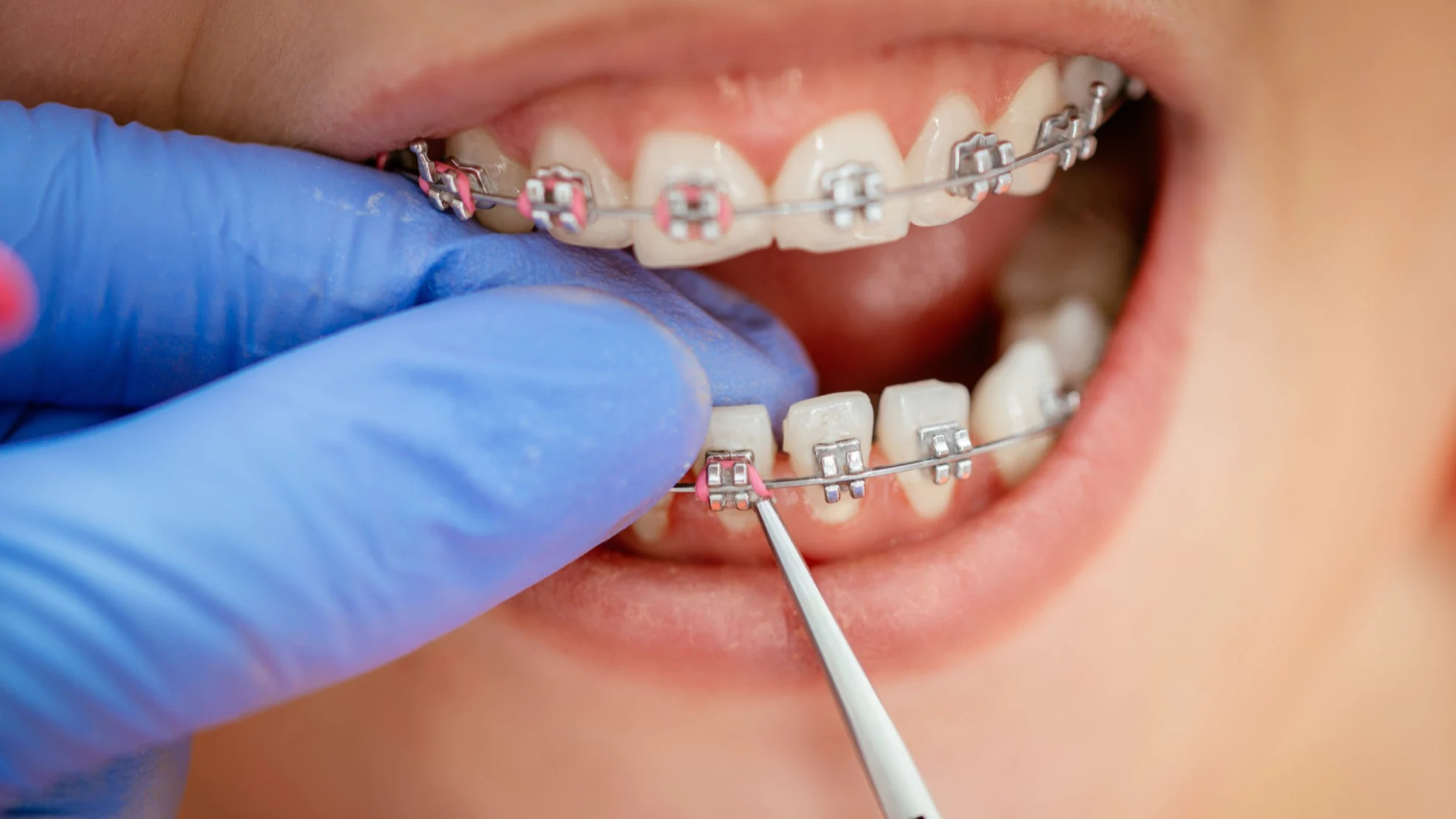 Dental braces in Howrah