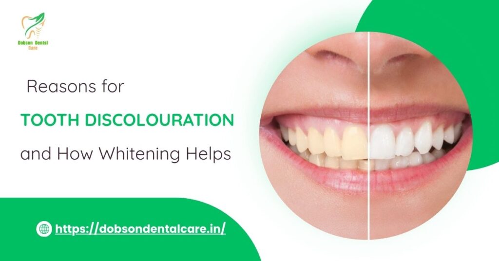 Reasons for Tooth Discolouration and How Whitening Helps