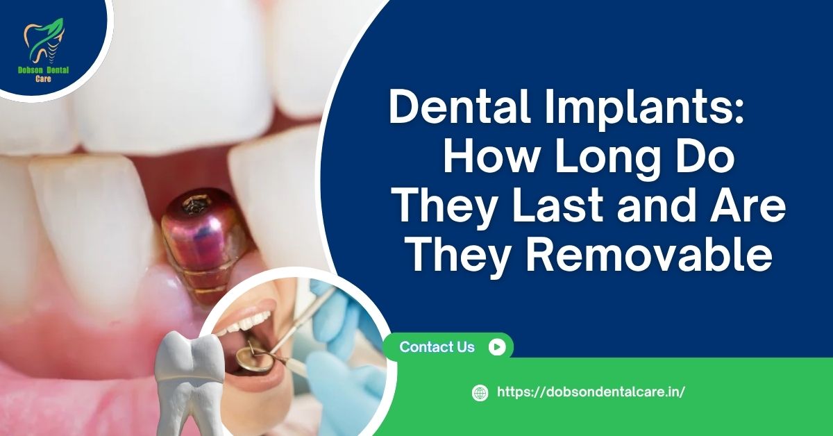 You are currently viewing Dental Implants: How Long Do They Last and Are They Removable